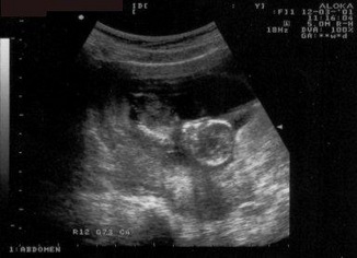 14 weken zwanger