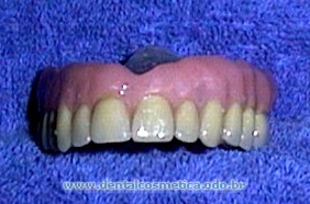 [img width=282 height=186 cacheid=00019e3a0003b1fa64ded7c51a00e57c00]http://www.dentalcosmetica.odo.br/fotos_casos/04124fim_so_protese.jpg[/img]