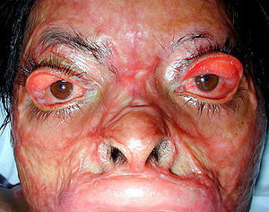 [img width=300 height=236 cacheid=0006ff110012ca7c8cc8adb3100169c720]http://upload.wikimedia.org/wikipedia/commons/thumb/1/1f/Verbrennungsnarbe_gesicht01.jpg/300px-Verbrennungsnarbe_gesicht01.jpg[/img]