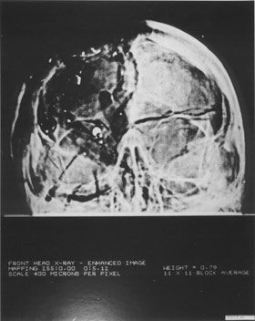 [img width=280 height=352 cacheid=000dbb2c002754dd6e77e69a1a01d21d85]http://www.history-matters.com/essays/jfkmed/How5Investigations/images/XRayAP.jpg[/img]