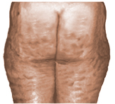[img width=162 height=147 cacheid=001177d2002eefffec68dd7d1a02b5e7da]http://www.fcaresystems.com/documents/graphics/cellulite/stage-3.jpg[/img]