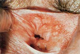 [img width=266 height=180 cacheid=0013ee600025fdc57caeeac11a01ac6dcf]http://www.akh-consilium.at/bilder/herpesgenitalis01.jpg[/img]