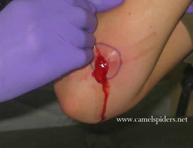 [img width=631 height=482 cacheid=0013f7eb0026abbb8ad62c641a01be4aba]http://www.thedailyspork.com/close-spider-bite.jpg[/img]